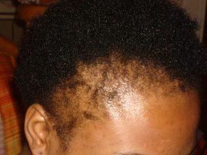 Hair Loss products for black women