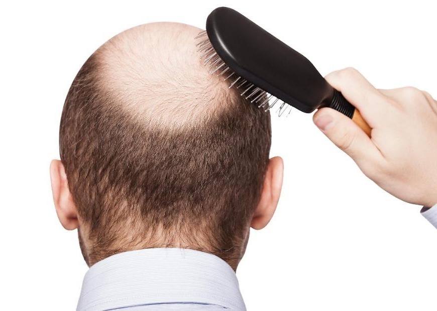 Balding, premature graying tied to higher heart disease risk