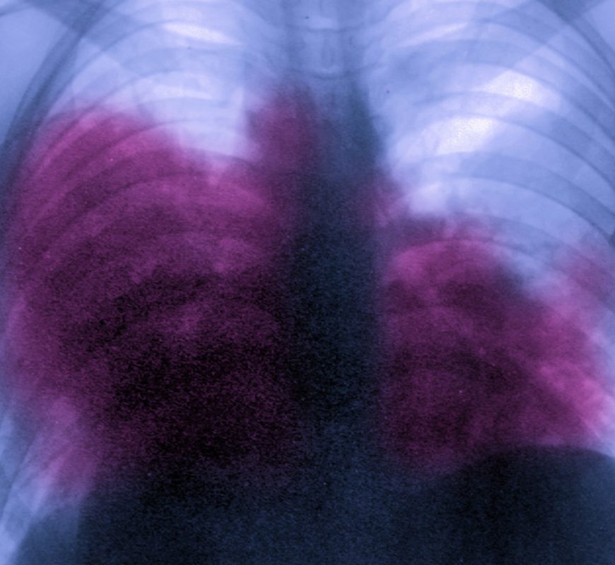 Legionnaires’ Disease Is Rising At An Alarming Rate In The U.S.