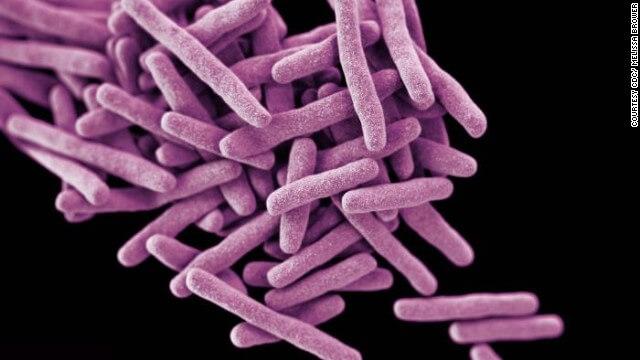 Possible release of tuberculosis bacteria investigated in Baltimore