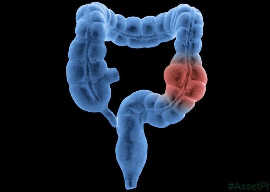 Colon cancer misdiagnosis in younger adults is a concern, study suggests