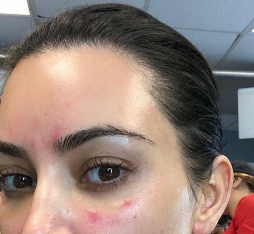 Kim Kardashian Shares Pic Of ‘Extremely Bad’ Psoriasis On Her Face