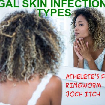 Fungal Infections – Common Types and Treatments
